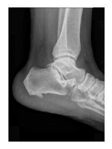 heel spur x ray